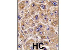 Formalin-fixed and paraffin-embedded human hepatocellular carcinoma reacted with ALDH5A1 polyclonal antibody  , which was peroxidase-conjugated to the secondary antibody, followed by DAB staining. (ALDH5A1 anticorps  (C-Term))