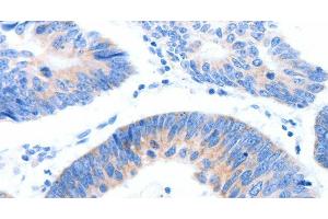 Immunohistochemistry of paraffin-embedded Human colon cancer tissue using MUC3A Polyclonal Antibody at dilution 1:60 (MUC3A anticorps)