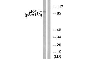Immunohistochemistry analysis of paraffin-embedded human breast carcinoma tissue using ERK3 (Phospho-Ser189) antibody. (MAPK6 anticorps  (pSer189))