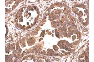 IHC-P Image EIF4A2 antibody detects EIF4A2 protein at cytosol on human ovarian carcinoma by immunohistochemical analysis. (EIF4A2 anticorps)