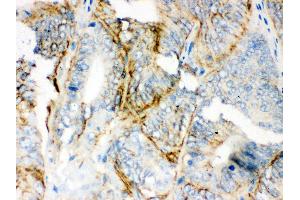 Anti-PKLR Picoband antibody, IHC(P) IHC(P): Human Intestinal Cancer Tissue