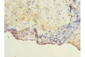 Immunohistochemistry of paraffin-embedded human breast cancer using ABIN7172926 at dilution of 1:100 (TM4SF1 anticorps  (AA 115-161))