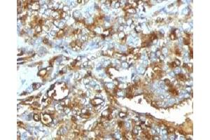 Formalin-fixed, paraffin-embedded human breast carcinoma stained with MUC-1 antibody. (MUC1 anticorps)