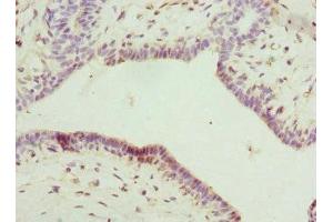 Immunohistochemistry of paraffin-embedded human breast cancer using ABIN7156859 at dilution of 1:100