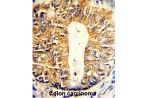 Formalin-fixed and paraffin-embedded human colon carcinoma reacted with Villin-1 Antibody (N-term), which was peroxidase-conjugated to the secondary antibody, followed by DAB staining.
