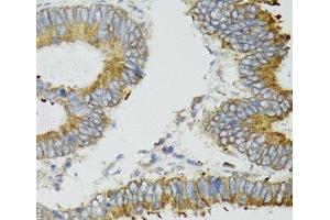 Immunohistochemistry of paraffin-embedded Human colon carcinoma using MT-ND5 Polyclonal Antibody at dilution of 1:100 (40x lens).