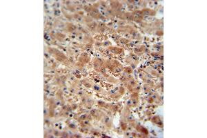 AS antibody (N-term) (ABIN654956 and ABIN2844596) immunohistochemistry analysis in formalin fixed and paraffin embedded human hepatocarcinoma followed by peroxidase conjugation of the secondary antibody and DAB staining. (ASAP3 anticorps  (N-Term))