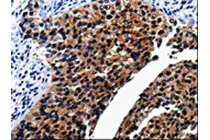 The image on the left is immunohistochemistry of paraffin-embedded Human renal cancer tissue using ABIN7189819(AP1B1 Antibody) at dilution 1/25, on the right is treated with synthetic peptide. (AP1B1 anticorps)