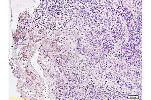 Formalin-fixed and paraffin embedded Human brain glioma labeled with Anti-PDGFRB Polyclonal Antibody, Unconjugated (ABIN726635) at 1:200 followed by conjugation to the secondary antibody and DAB staining