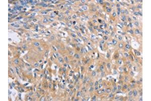 The image on the left is immunohistochemistry of paraffin-embedded Human cervical cancer tissue using ABIN7191576(NBEA Antibody) at dilution 1/60, on the right is treated with synthetic peptide. (Neurobeachin anticorps)