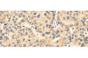 Immunohistochemistry of paraffin-embedded Human liver cancer tissue using TWIST2 Polyclonal Antibody at dilution 1:35 (TWIST2 anticorps)