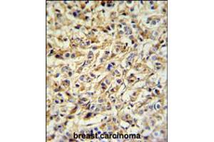 PRELP Antibody IHC analysis in formalin fixed and paraffin embedded breast carcinoma followed by peroxidase conjugation of the secondary antibody and DAB staining.
