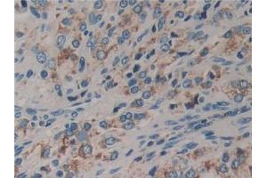 IHC-P analysis of Human Prostate cancer Tissue, with DAB staining. (DVL2 anticorps  (AA 78-250))