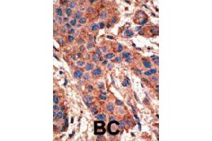 Formalin-fixed and paraffin-embedded human cancer tissue reacted with BMPR1A polyclonal antibody  , which was peroxidase-conjugated to the secondary antibody, followed by AEC staining. (BMPR1A anticorps  (AA 39-69))