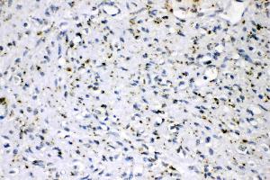 ADFP was detected in paraffin-embedded sections of human mammary cancer tissues using rabbit anti- ADFP Antigen Affinity purified polyclonal antibody (Catalog # ) at 1 µg/mL.