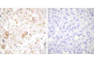Peptide - +Immunohistochemical analysis of paraffin-embedded human breast carcinoma tissue using Cyclin F antibody (#C0168). (Cyclin F anticorps)