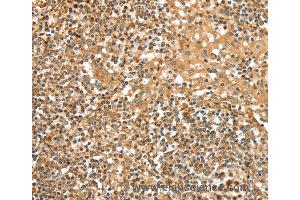 Immunohistochemistry of Human cervical cancer using SLC8A3 Polyclonal Antibody at dilution of 1:35 (SLC8A3 anticorps)