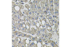 Immunohistochemistry of paraffin-embedded human liver injury using GFPT1 antibody. (GFPT1 anticorps)