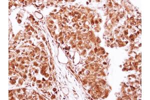 IHC-P Image Immunohistochemical analysis of paraffin-embedded CL1-0 xenograft, using Casein Kinase 2 beta, antibody at 1:100 dilution.