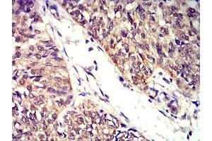 Immunohistochemical analysis of paraffin-embedded bladder cancer tissues using BTN2A2 mouse mAb with DAB staining.