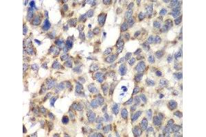 Immunohistochemistry of paraffin-embedded Human esophageal cancer using PARN Polyclonal Antibody at dilution of 1:100 (40x lens). (PARN anticorps)