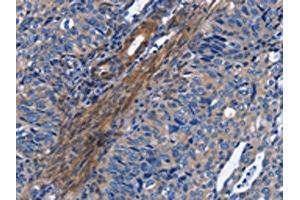 The image on the left is immunohistochemistry of paraffin-embedded Human cervical cancer tissue using ABIN7130344(NAT8 Antibody) at dilution 1/50, on the right is treated with fusion protein.