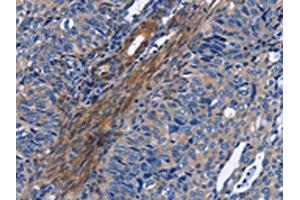 The image on the left is immunohistochemistry of paraffin-embedded Human cervical cancer tissue using ABIN7130344(NAT8 Antibody) at dilution 1/50, on the right is treated with fusion protein. (NAT8 anticorps)