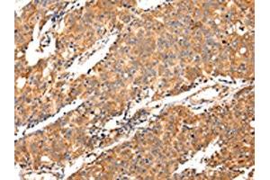The image on the left is immunohistochemistry of paraffin-embedded Human prostate cancer tissue using ABIN7130145(MAP2 Antibody) at dilution 1/20, on the right is treated with fusion protein. (MAP2 anticorps)