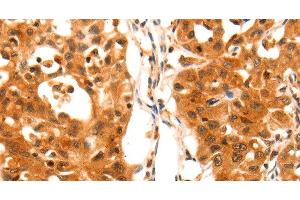 Immunohistochemistry of paraffin-embedded Human lung cancer using SERPINB5 Polyclonal Antibody at dilution of 1:60 (SERPINB5 anticorps)