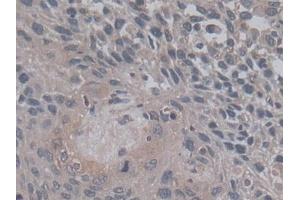 DAB staining on IHC-P; Samples: Human Lung cancer Tissue) (TGFB3 anticorps  (AA 24-300))
