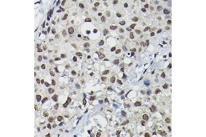 Immunohistochemistry of paraffin-embedded human breast cancer using Cyclin K Rabbit pAb (ABIN6128996, ABIN6138098, ABIN6138099 and ABIN6214445) at dilution of 1:100 (40x lens). (Cyclin K anticorps  (AA 1-160))