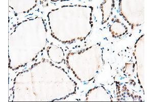 Immunohistochemical staining of paraffin-embedded Adenocarcinoma of Human colon tissue using anti-MTRF1L mouse monoclonal antibody. (MTRF1L anticorps)
