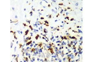 Immunohistochemistry of paraffin-embedded Human liver cancer using CAPG Polyclonal Antibody at dilution of 1:100 (40x lens). (CAPG anticorps)