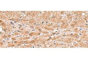 Immunohistochemistry of paraffin-embedded Human liver cancer tissue using HMGCLL1 Polyclonal Antibody at dilution of 1:70(x200) (HMGCLL1 anticorps)