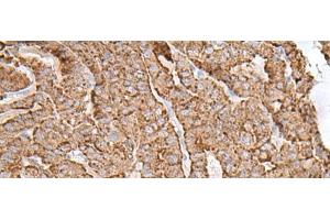 Immunohistochemistry of paraffin-embedded Human thyroid cancer tissue using AP1S1 Polyclonal Antibody at dilution of 1:65(x200) (AP1S1 anticorps)