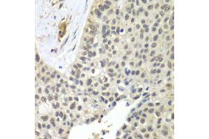 Immunohistochemistry of paraffin-embedded human lung cancer using SNRPD2 antibody.