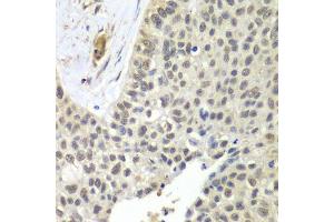 Immunohistochemistry of paraffin-embedded human lung cancer using SNRPD2 antibody. (SNRPD2 anticorps  (AA 1-118))