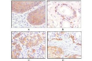Immunohistochemical analysis of paraffin-embedded human esophagus epithelium (A), salivary gland basal cell (B), lung squamous cell carcinoma (C), endometrium admosquamous carcinoma (D), showing cytoplasmic and membrane localization using CK5 mouse mAb with DAB staining. (Cytokeratin 5 anticorps)