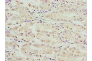 Immunohistochemistry of paraffin-embedded human gastric cancer using ABIN7168087 at dilution of 1:100