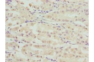 Immunohistochemistry of paraffin-embedded human gastric cancer using ABIN7168087 at dilution of 1:100 (RIBC2 anticorps  (AA 1-309))