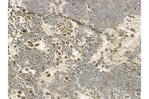 ABIN6258315 and ABIN6274373 at 1/100 staining human melanoma by IHC-P.