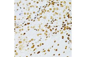 Immunohistochemistry of paraffin-embedded human cancer using DKC1 Antibody (ABIN3022640, ABIN3022641, ABIN1512829 and ABIN6218993) at dilution of 1:200 (40x lens). (DKC1 anticorps  (AA 245-514))