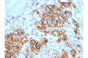 Formalin-fixed, paraffin-embedded human Gastric Carcinoma stained with CA19-9 Mouse Monoclonal Antibody (121SLE). (CA 19-9 anticorps)