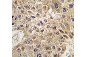 IHC analysis of FFPE human hepatocarcinoma tissue stained with AMFR antibody (AMFR anticorps  (AA 571-601))