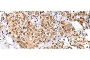 Immunohistochemistry of paraffin-embedded Human breast cancer tissue using KEAP1 Polyclonal Antibody at dilution of 1:35(x200) (KEAP1 anticorps)