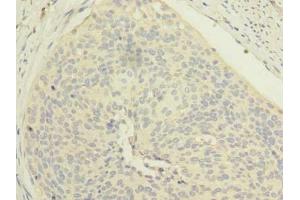 Immunohistochemistry of paraffin-embedded human cervical cancer using ABIN7151982 at dilution of 1:100