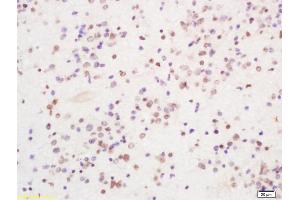 Formalin-fixed and paraffin embedded human glioma tissue labeled with Anti PIRH2 Polyclonal Antibody, Unconjugated (ABIN1386185) at 1:200 followed by conjugation to the secondary antibody and DAB staining