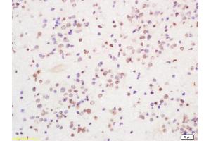 Formalin-fixed and paraffin embedded human glioma tissue labeled with Anti PIRH2 Polyclonal Antibody, Unconjugated (ABIN1386185) at 1:200 followed by conjugation to the secondary antibody and DAB staining (RCHY1 anticorps  (AA 31-130))