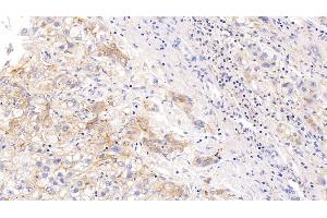 Detection of ICAM1 in Human Liver cancer Tissue using Monoclonal Antibody to Intercellular Adhesion Molecule 1 (ICAM1)