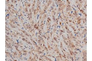 ABIN6269240 at 1/200 staining human breast cancer tissue sections by IHC-P. (STAT3 anticorps  (C-Term))